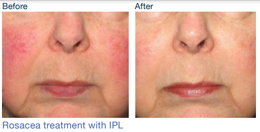 stellar m22 before&after3Skinspire Laser&Skin Clinic