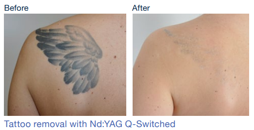 stellar m22 before&afterSkinspire Laser&Skin Clinic