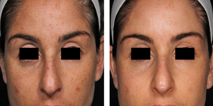 picosure before and after